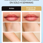 Depiladora Laser IPL